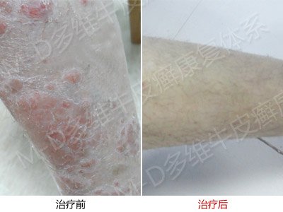脓疱型银屑病的病因是什么