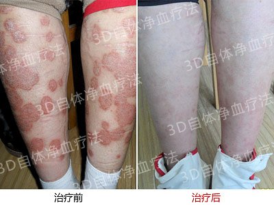 牛皮癣会直接给患者带来哪些危害