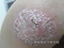 银屑病症状