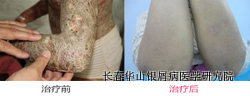 银屑病症状治疗