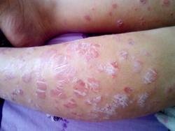 牛皮癣怎么排毒 牛皮癣怎么排毒