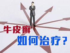 牛皮癣怎样治疗才有效果